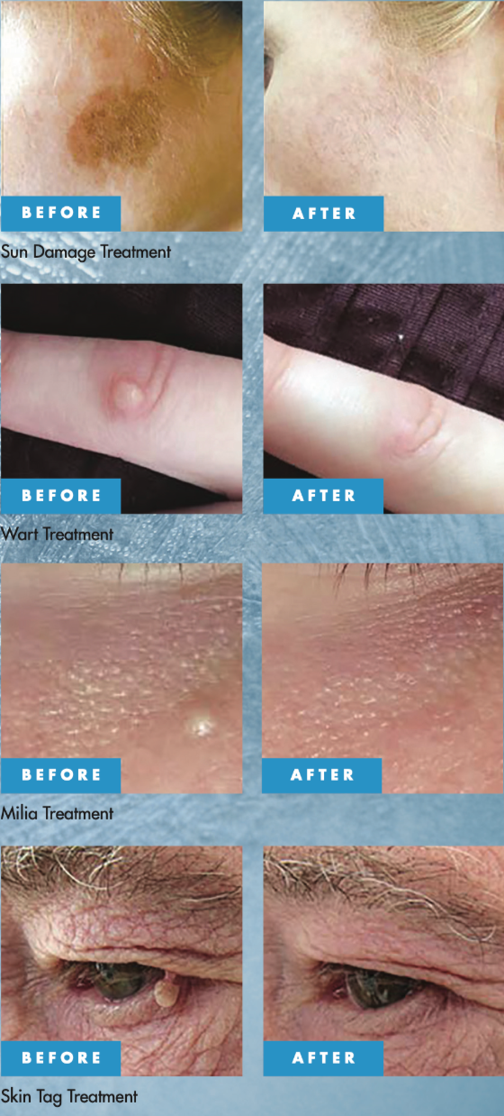 Cryotherapy before and after for benign skin lesion treatment in Bristol