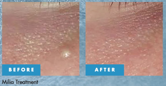 Before and after Cryotherapy treatment for skin tags and benign skin lesions in Bristol