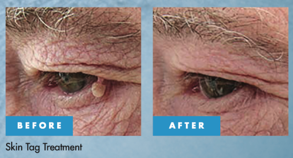 Cryotherapy before and after for benign skin lesion removal near the eye