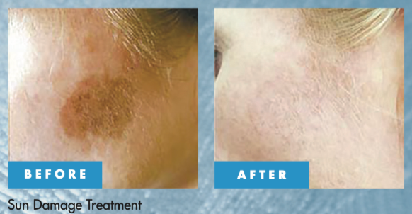 Cryotherapy before and after for sun damage and age spot removal