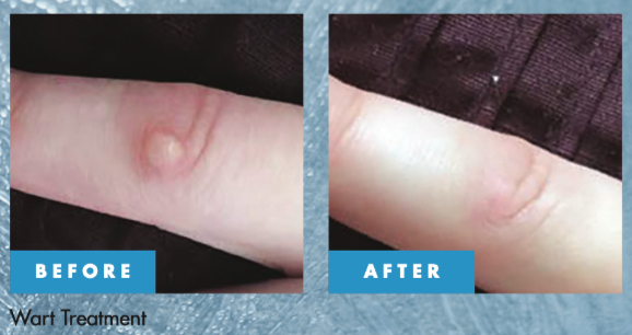 Professional Wart & Verruca Treatment