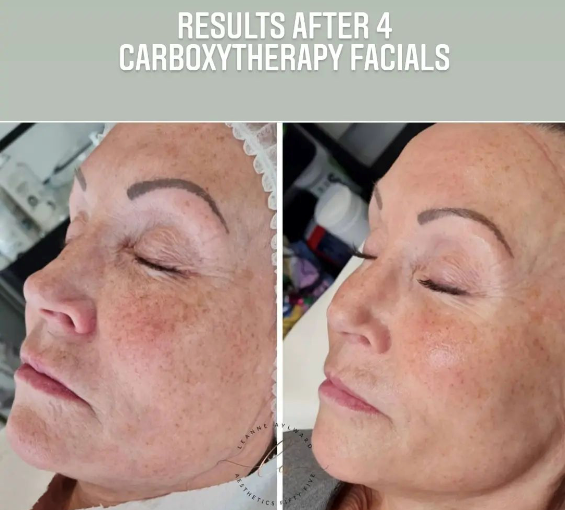 Carboxy Therapy facial for dull tired skin at Jax-Glam Beauty