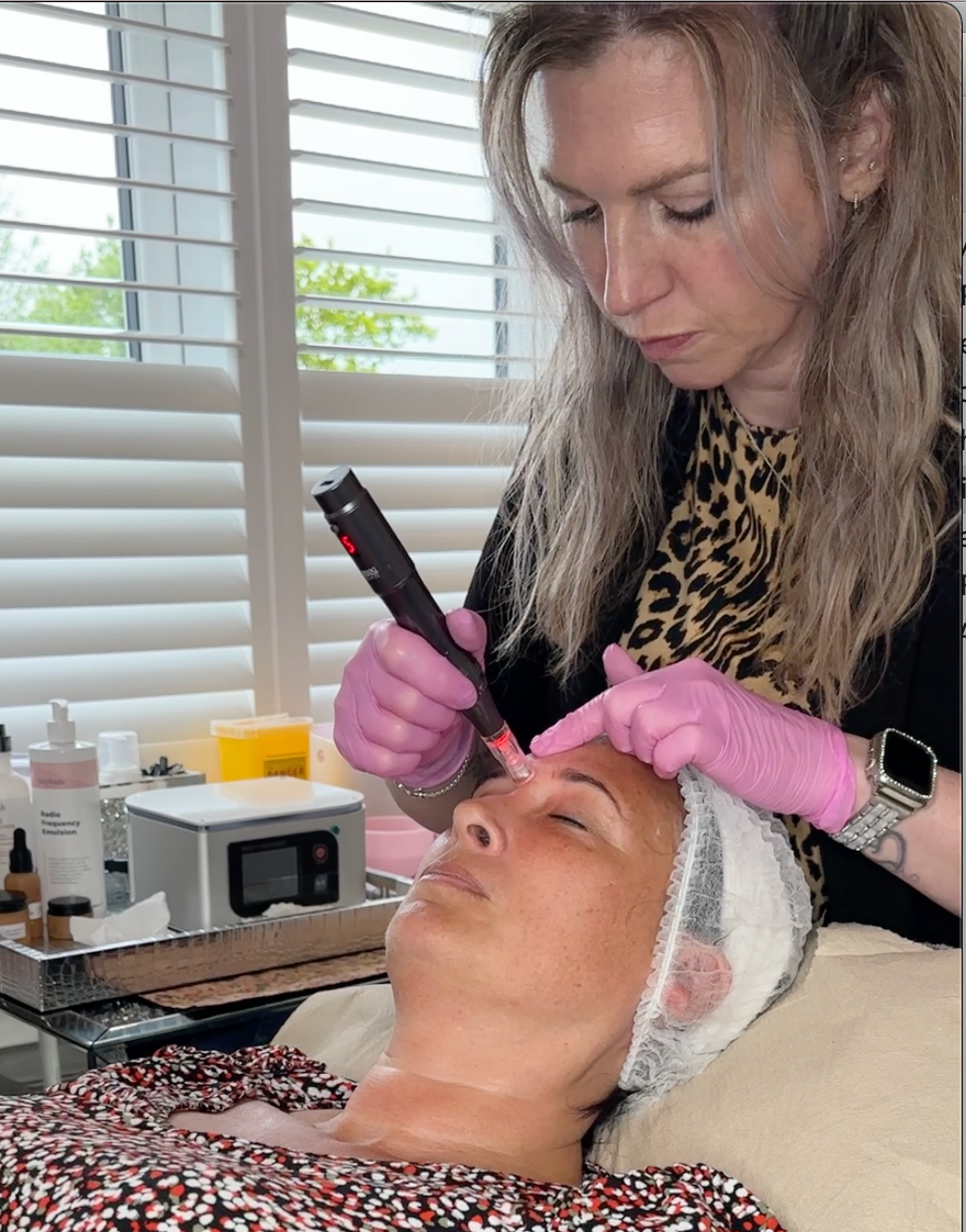 Professional microneedling facial treatment at Jax-Glam Beauty Bristol