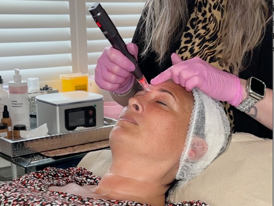 Microneedling facial treatment in Bristol improving skin texture fine lines in private beauty salon