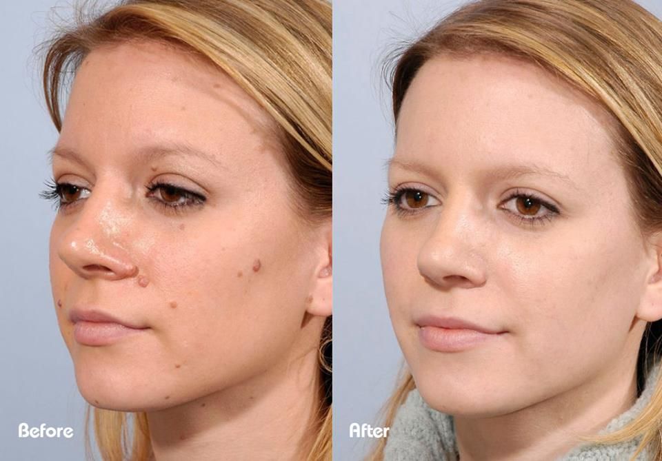 Before and after cosmetic skin lesion removal showing clearer skin