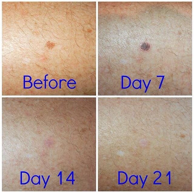 Cryotherapy healing progress for pigmentation removal before and after day seven