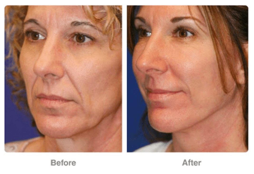 radio frequency facial before and after skin treatment by Jax-Glam Beauty Bristol