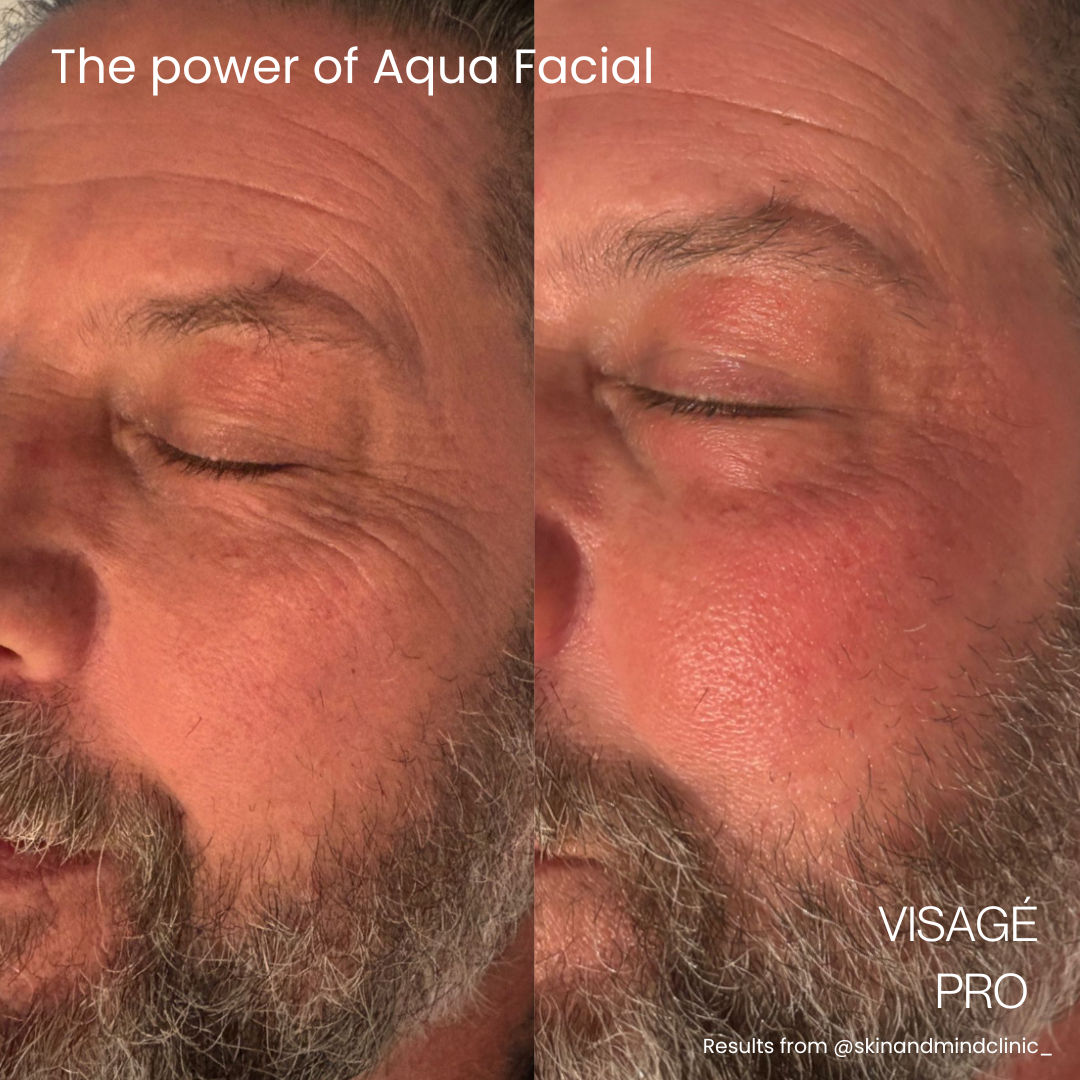aqua pro hydration facial treatment results by Jax-Glam Beauty Bristol