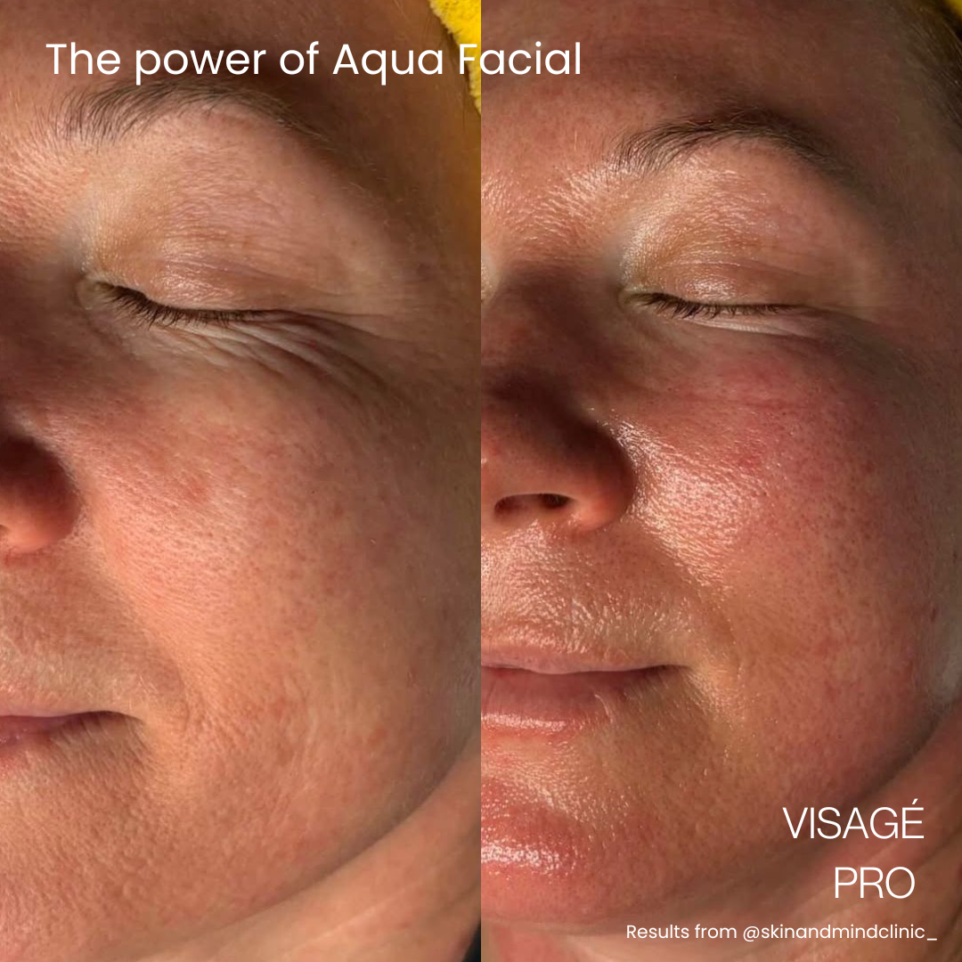 aqua pro hydration facial skin results by Jax-Glam Beauty Bristol