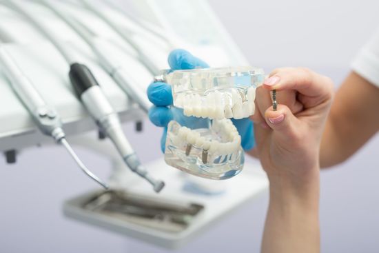 Dental Implant Model