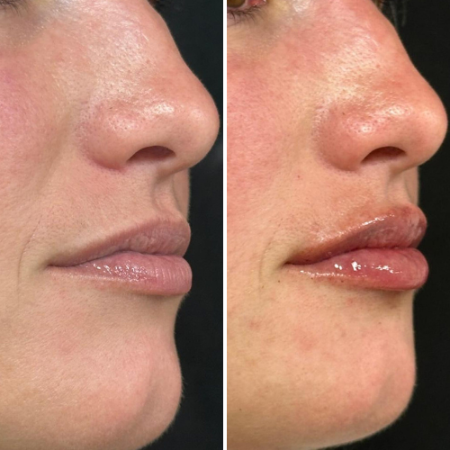 Comparison of side profiles: before and after lip augmentation. Both have pale skin and slight smiles.