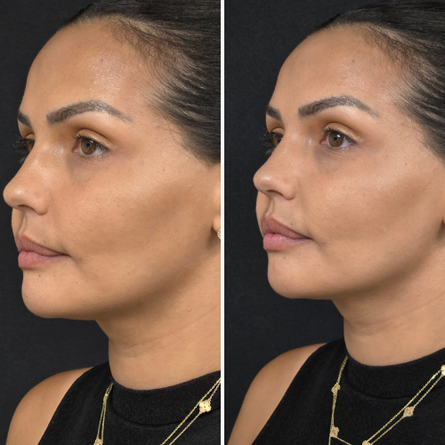 Side-by-side photos comparing before and after jawline contouring. The subject's jawline is more defined in the after photo.