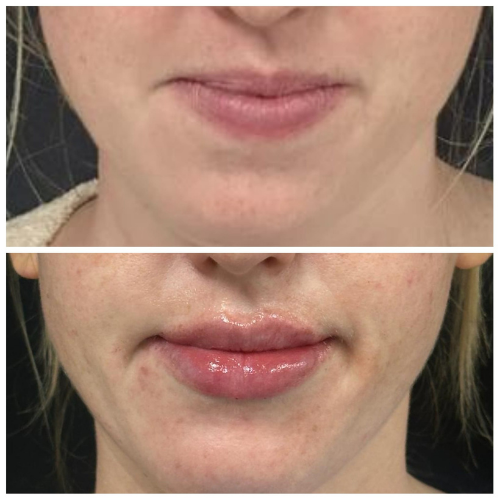 Before and after lip filler treatment: thin lips before, fuller lips after.