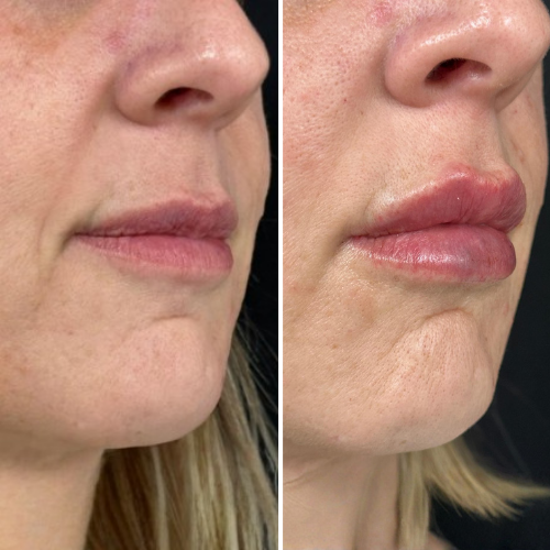 Comparison: lips before and after filler; fuller, more defined lips on the right.