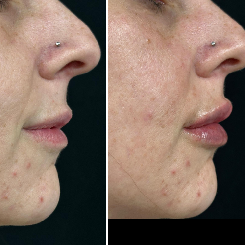 Side-by-side view of a face. Left: wrinkled skin. Right: smoother skin, fuller lips. Nose piercing present.
