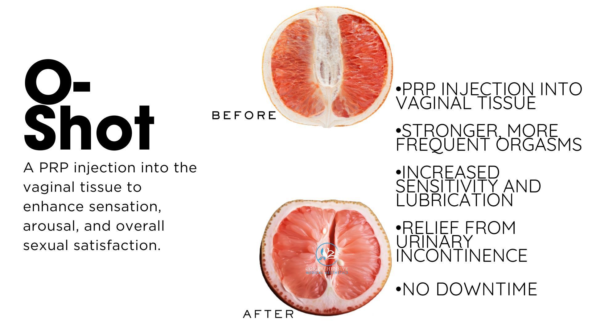 Diagram of the O-Shot procedure using a grapefruit analogy, with