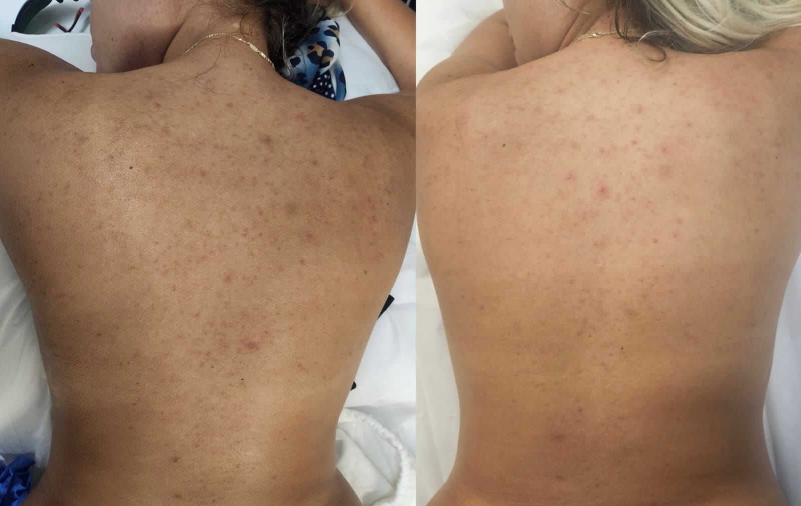 Side-by-side comparison of a person's back before (left) and after (right) acne treatment, showing reduced blemishes.