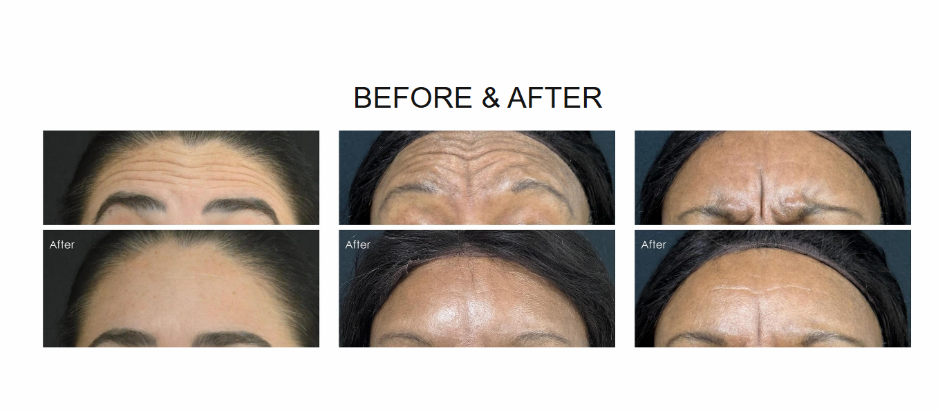 Before and after images of forehead wrinkles; before: wrinkles; after: smooth.