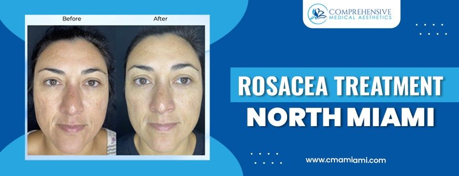 Before and After images of rosacea treatment in North Miami. A woman's face improves after treatment.