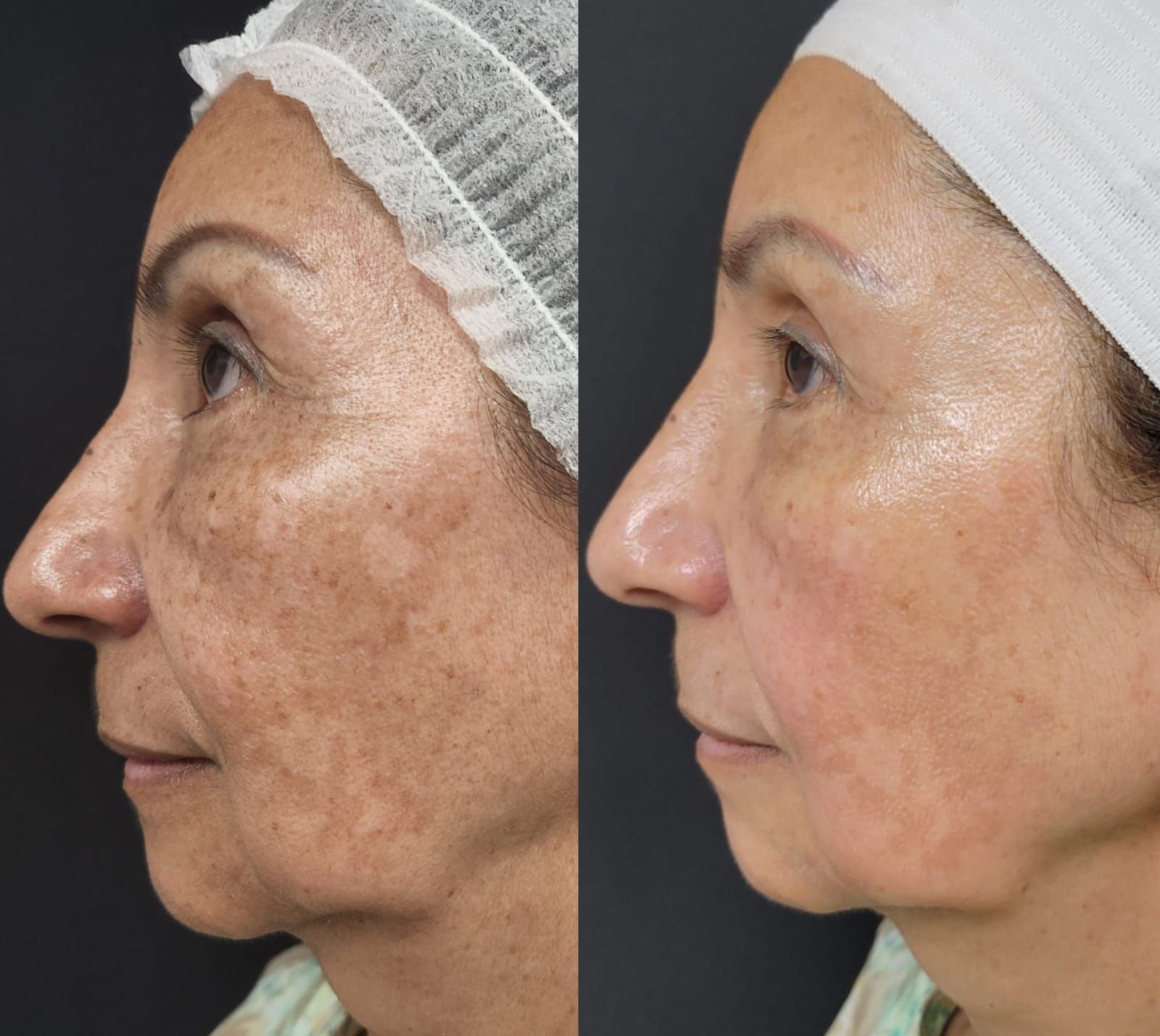 Side-by-side comparison of a person's face. Left side shows skin with dark spots; right side shows improved skin tone.