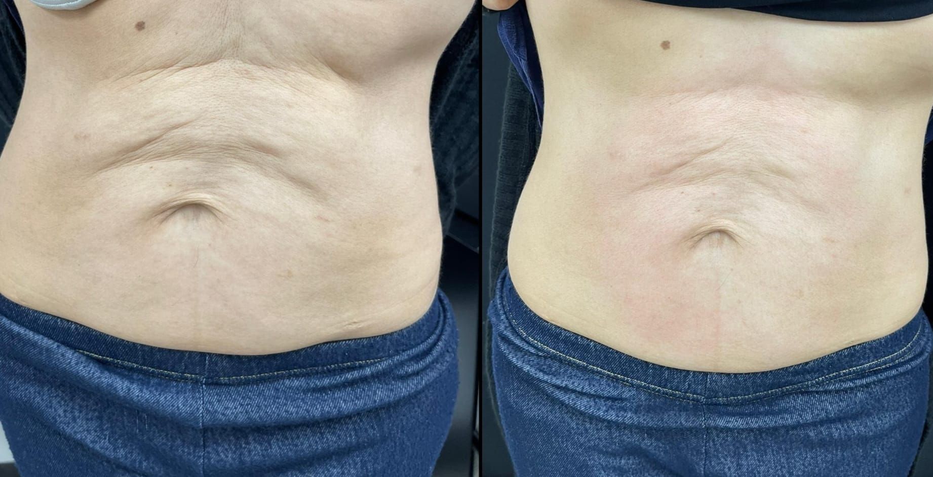 Two side-by-side photos of a person's abdomen, before and after treatment, showing a reduction in skin folds.