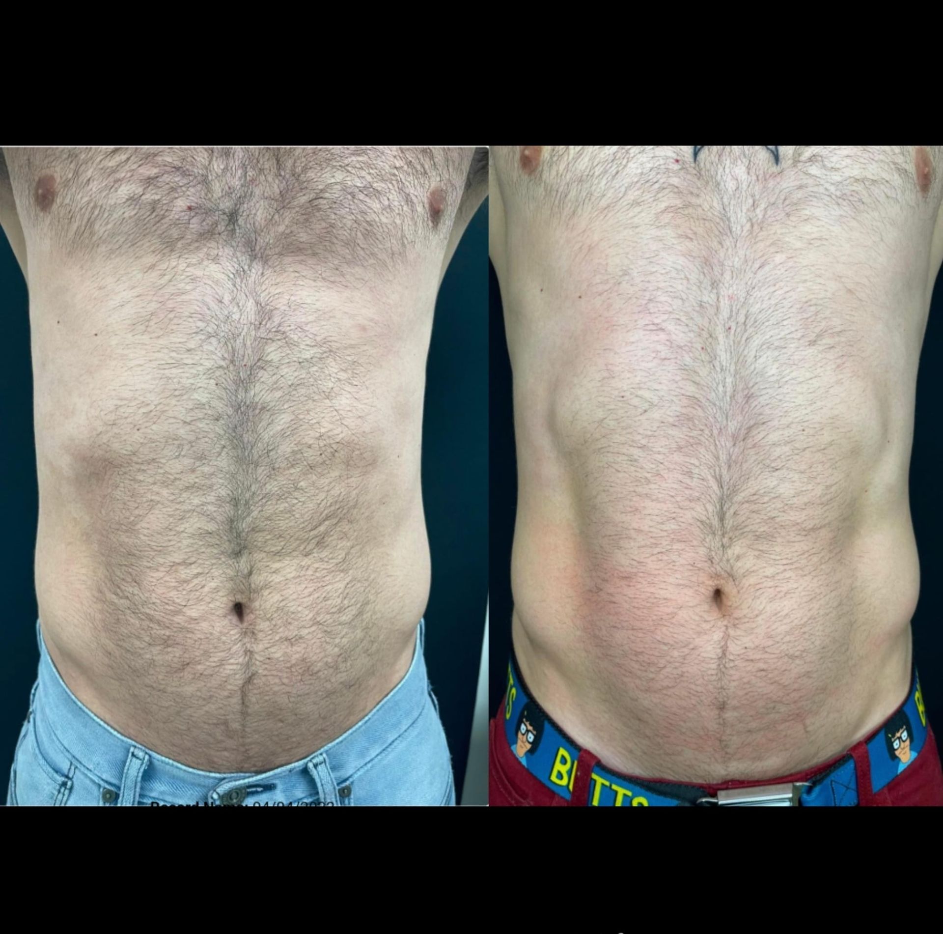 Before and after torso photos. Abdomen shows definition change, with less fat in the second photo.