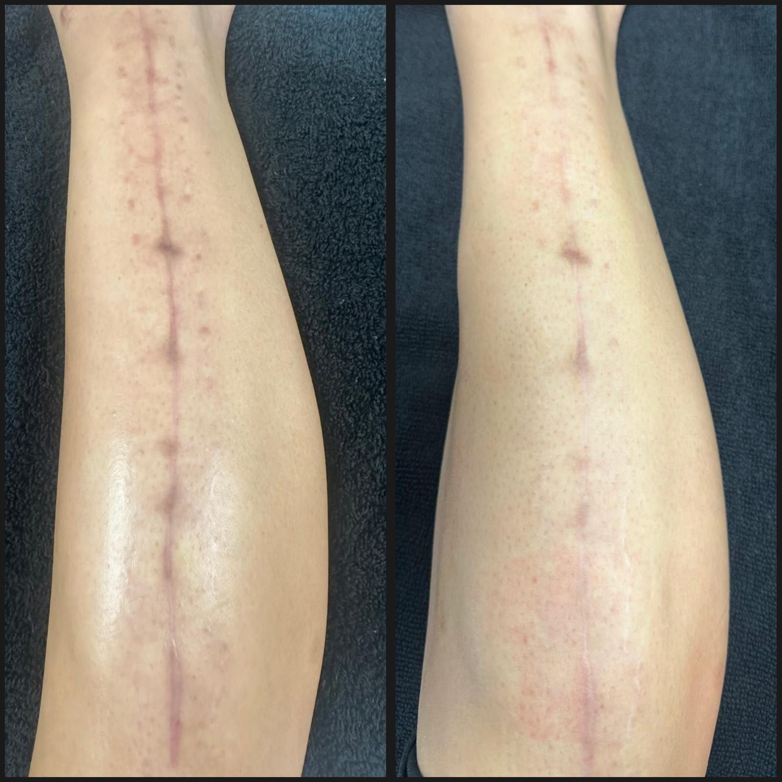Two views of a leg with a long scar down the center. One view is shiny, the other matte.