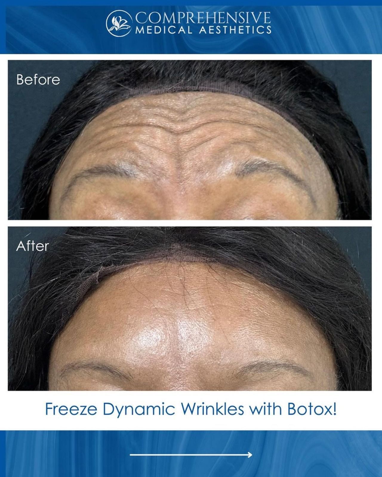 Before and after photos of a forehead; wrinkles visible before, smoothed after Botox treatment.