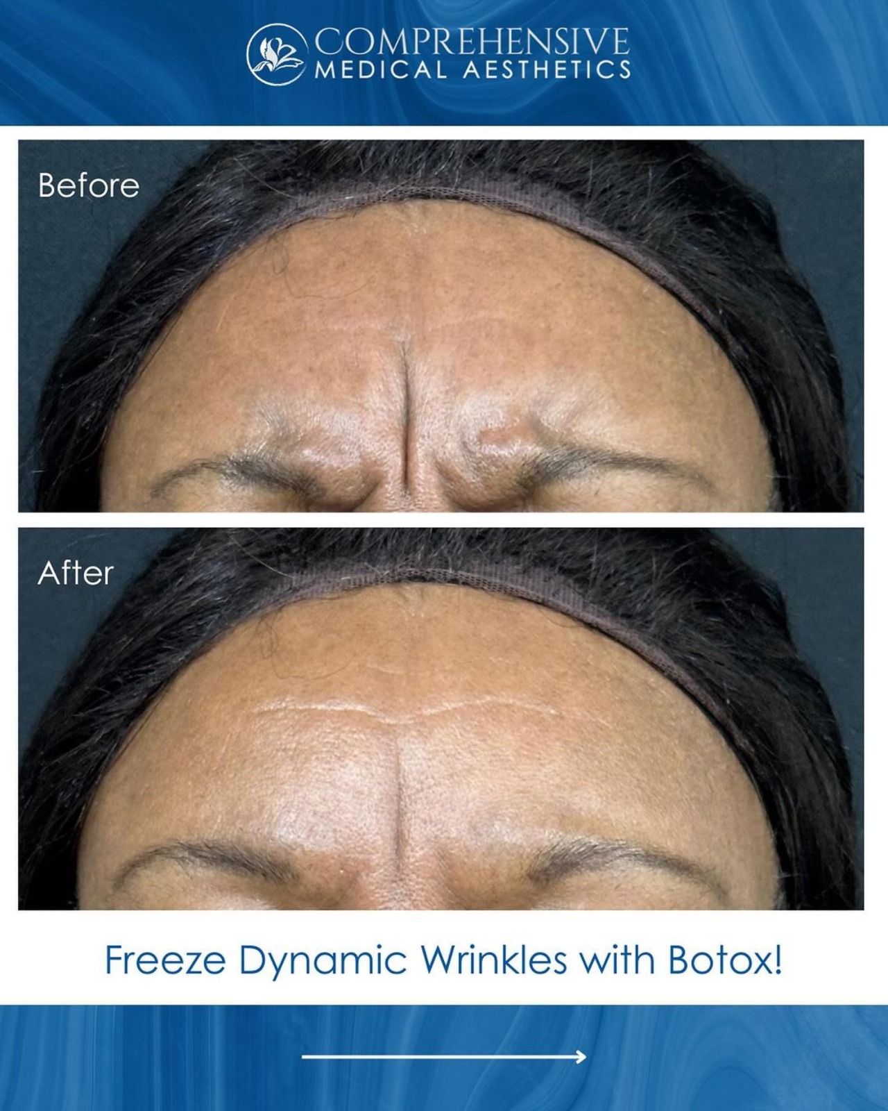 Before and after showing smoothed forehead wrinkles after Botox treatment.