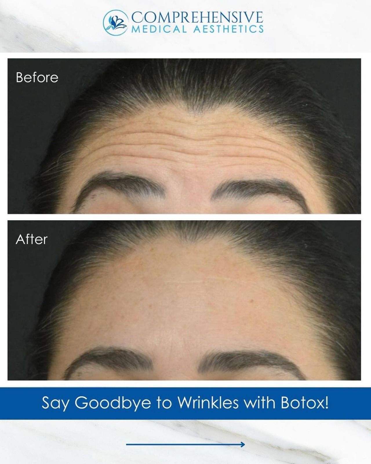 Before and after images of forehead with wrinkles, then smooth after Botox treatment.