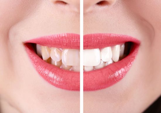 sbiancamento dentale