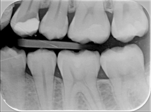 visita denti cariati