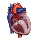 Diagram of HCM heart with
obstruction