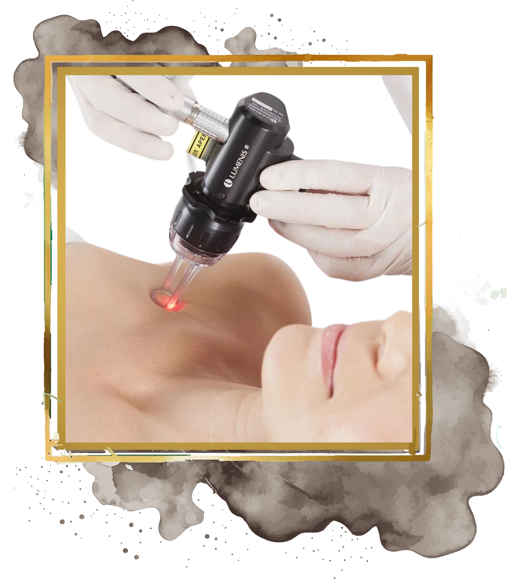 Acupulse™