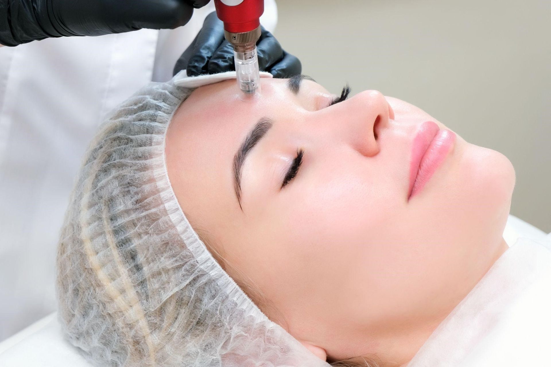 Guide to the Microneedling Process