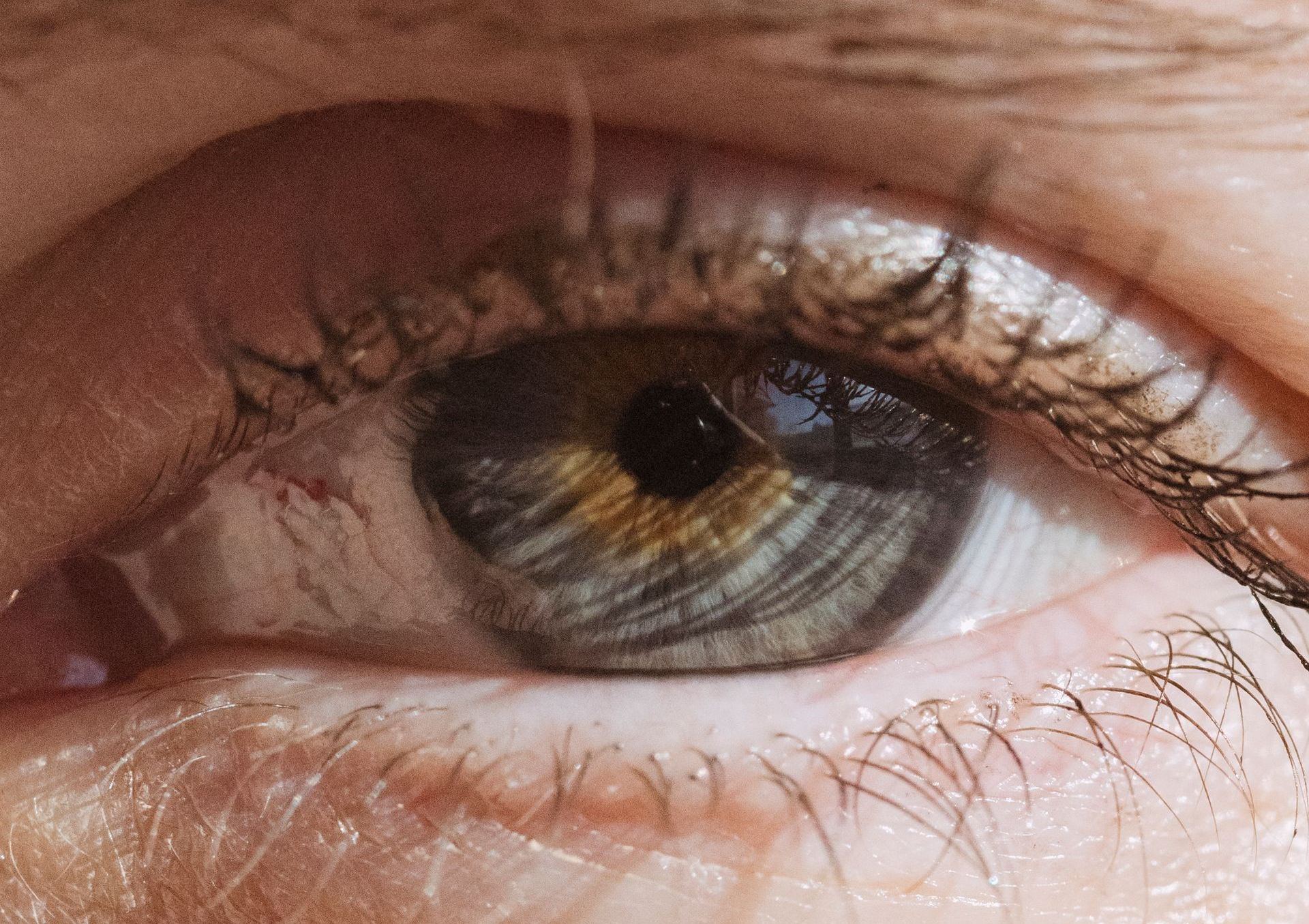 Cataract Surgery and macular degeneration.