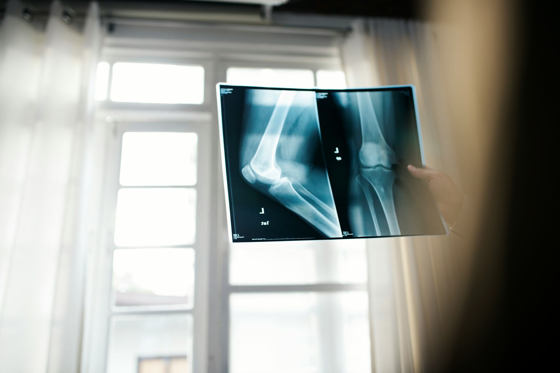 X-ray film of an elbow held up against a bright window