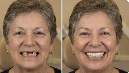 Dentures