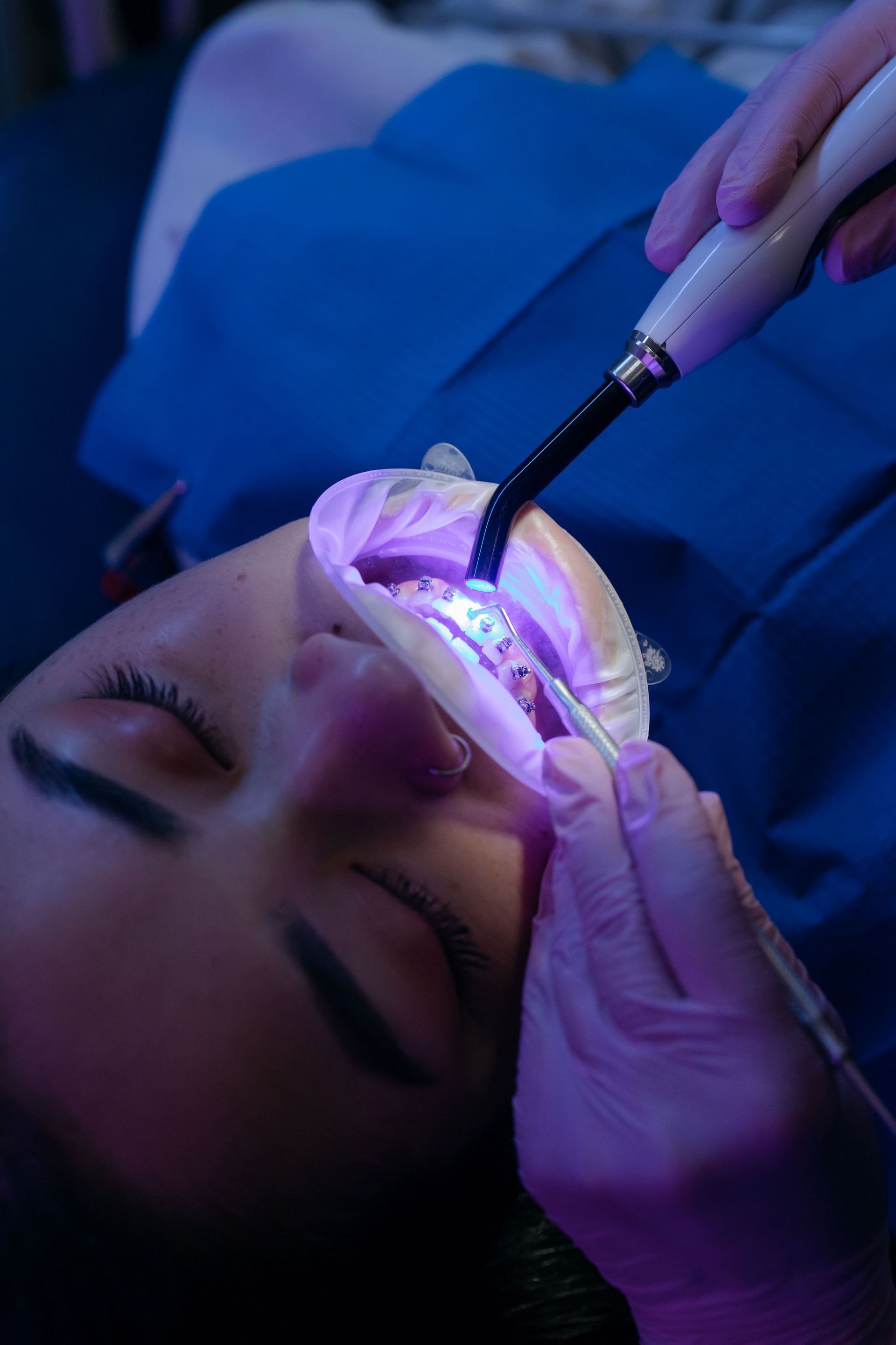 Advanced dental whitening technology
