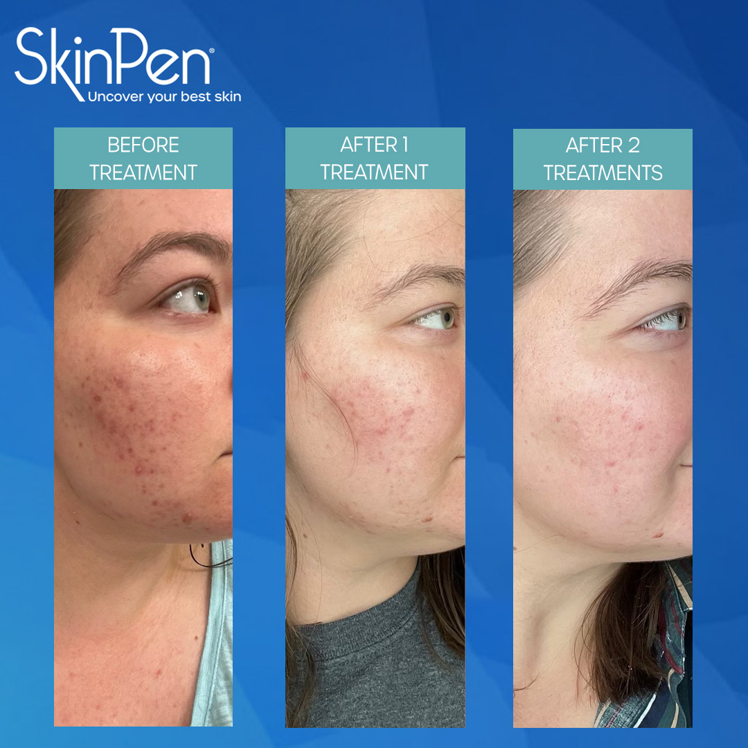 SkinPen treatment results: before, after 1, and after 2 treatments. Red scar reduction on a person's face.