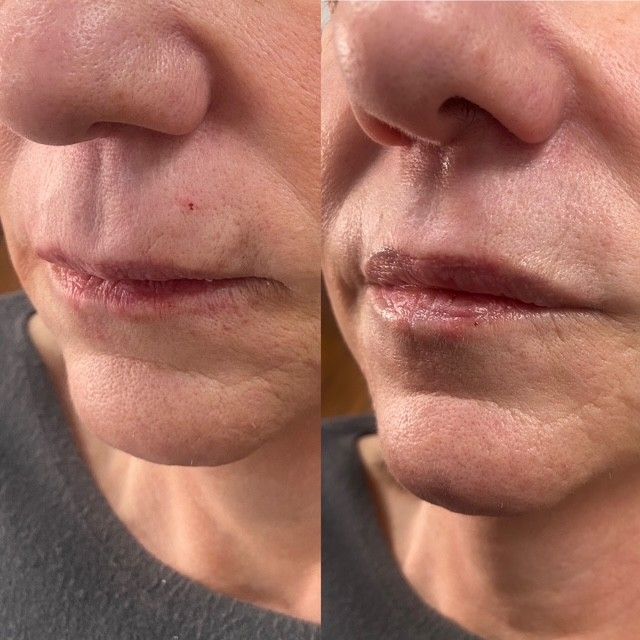 Side-by-side comparison of a person's lips. The before photo shows fine lines, the after photo displays fuller lips.