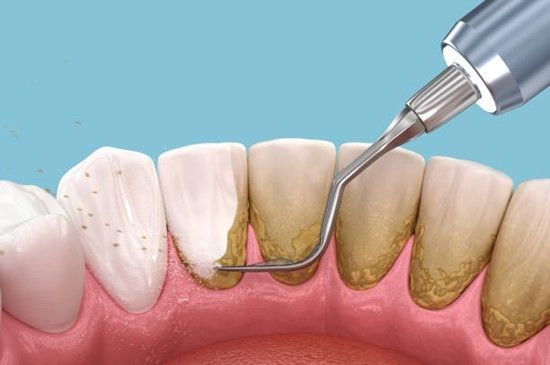A close up of a person 's teeth being cleaned with a toothbrush.