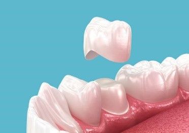 A dental crown is being placed on a tooth.