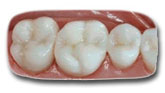 After CEREC CAD Cam Ceramic Restoration - Pittsburgh PA