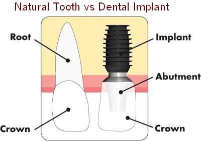 What is the difference between Natural Teeth & Dental Implant - Pittsburgh PA