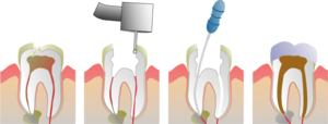 How a root canal is proformed on a Molar.