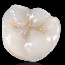 Shiny porcelain molar inlay crown