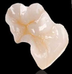 Shiny porcelain molar inlay crown