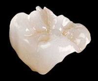 Shiny porcelain molar onlay crown