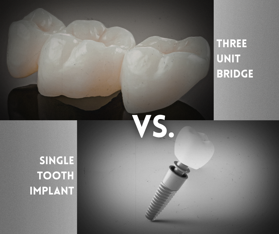 Three-unit bridge vs single tooth implant comparison, with dental restoration images and implant screw.